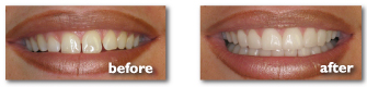 BeforeAfter_Teeth_1