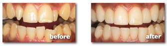 BeforeAfter_Teeth_2