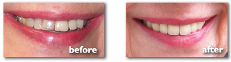 BeforeAfter_Teeth_3