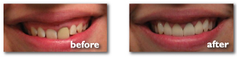 BeforeAfter_Teeth_4